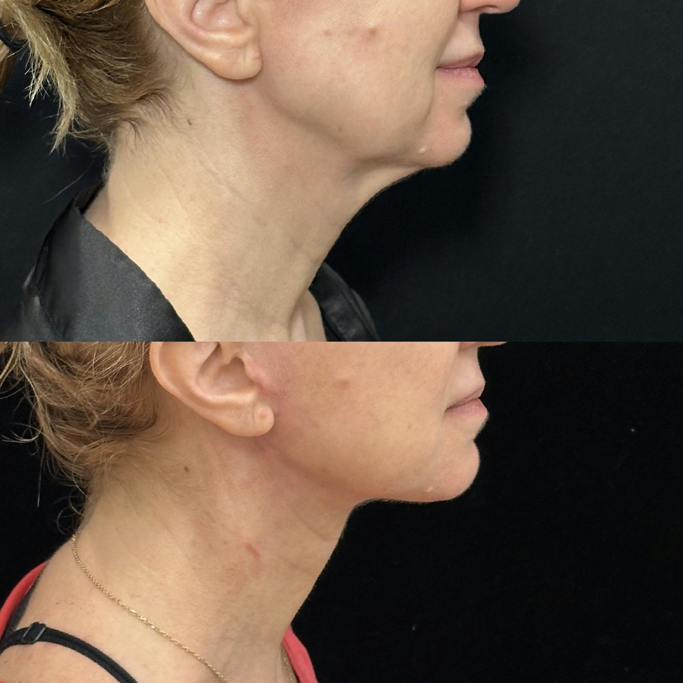 Deep Plane Facelift Before & After Gallery - Patient 116037 - Image 4