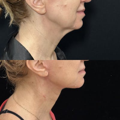 Deep Plane Facelift Before & After Gallery - Patient 116037 - Image 4