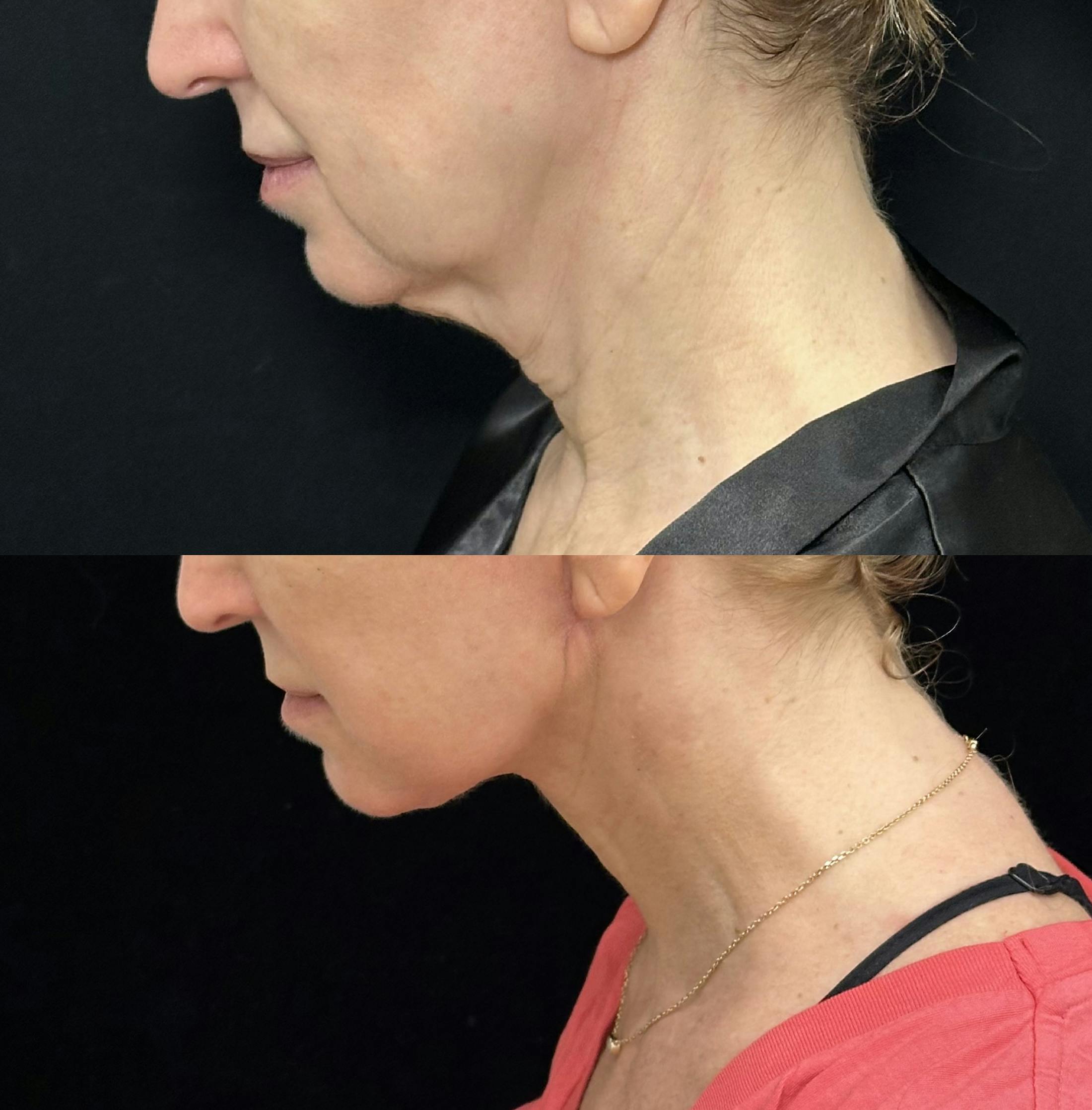Deep Plane Facelift Before & After Gallery - Patient 116037 - Image 2