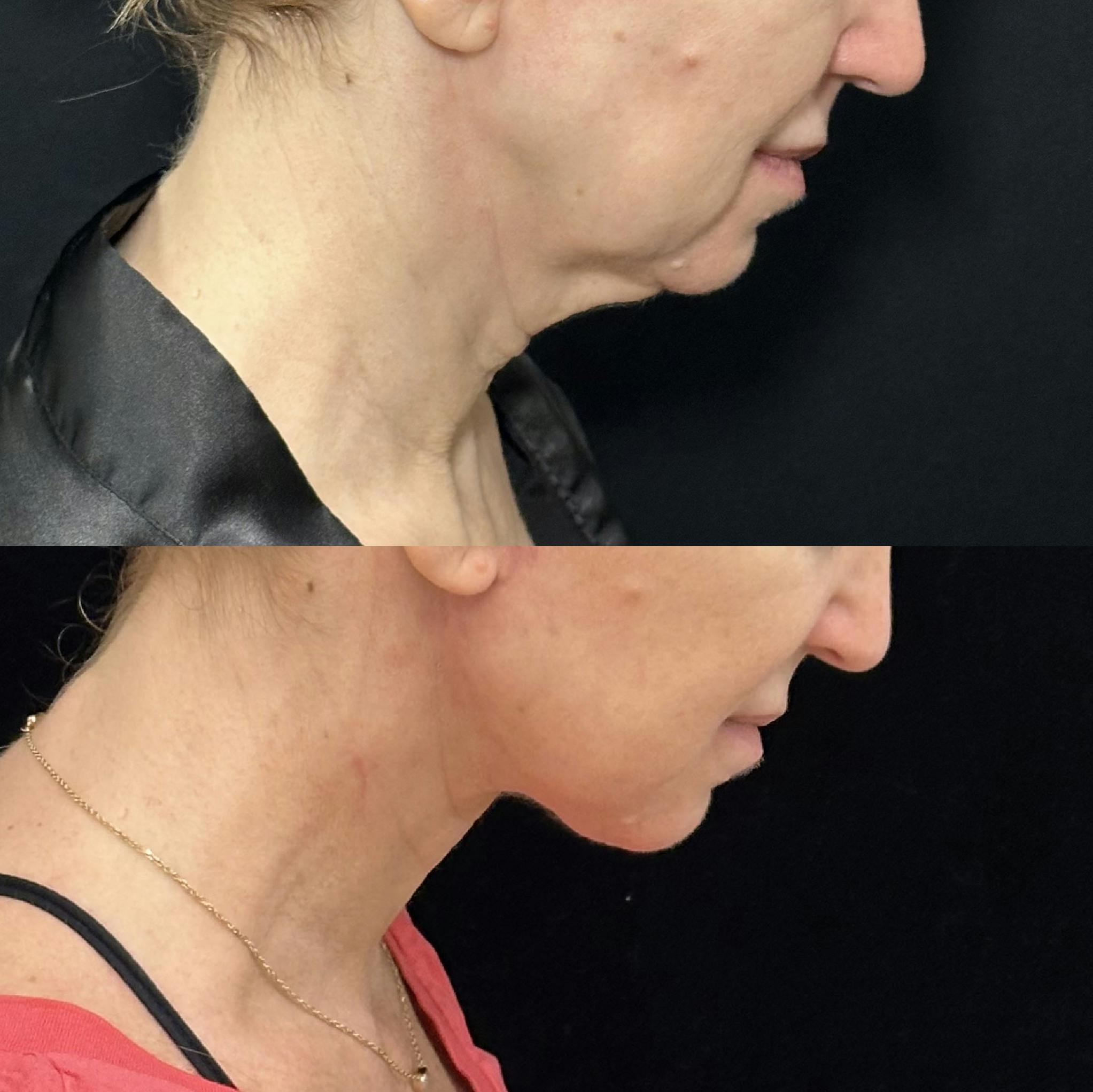 Deep Plane Facelift Before & After Gallery - Patient 116037 - Image 1