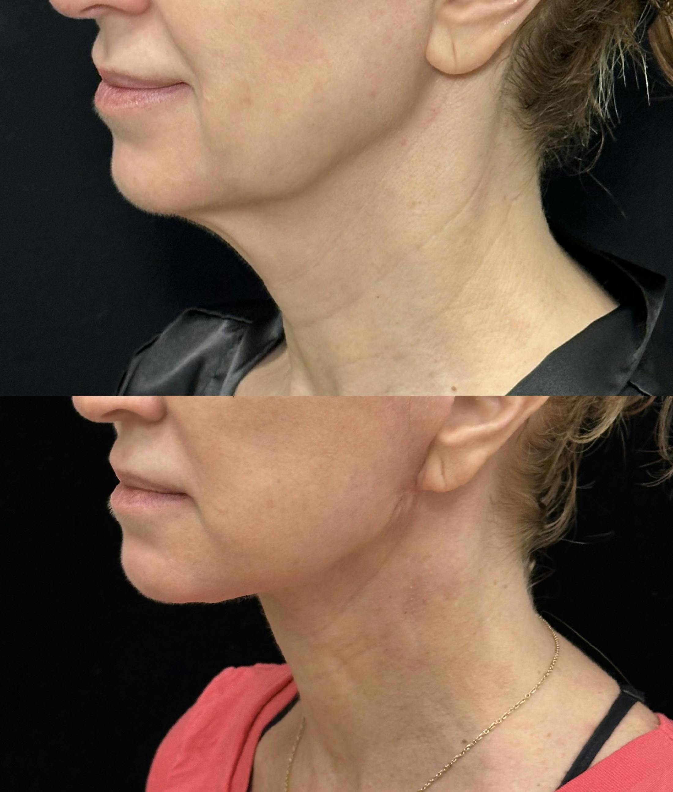 Deep Plane Facelift Before & After Gallery - Patient 116037 - Image 5