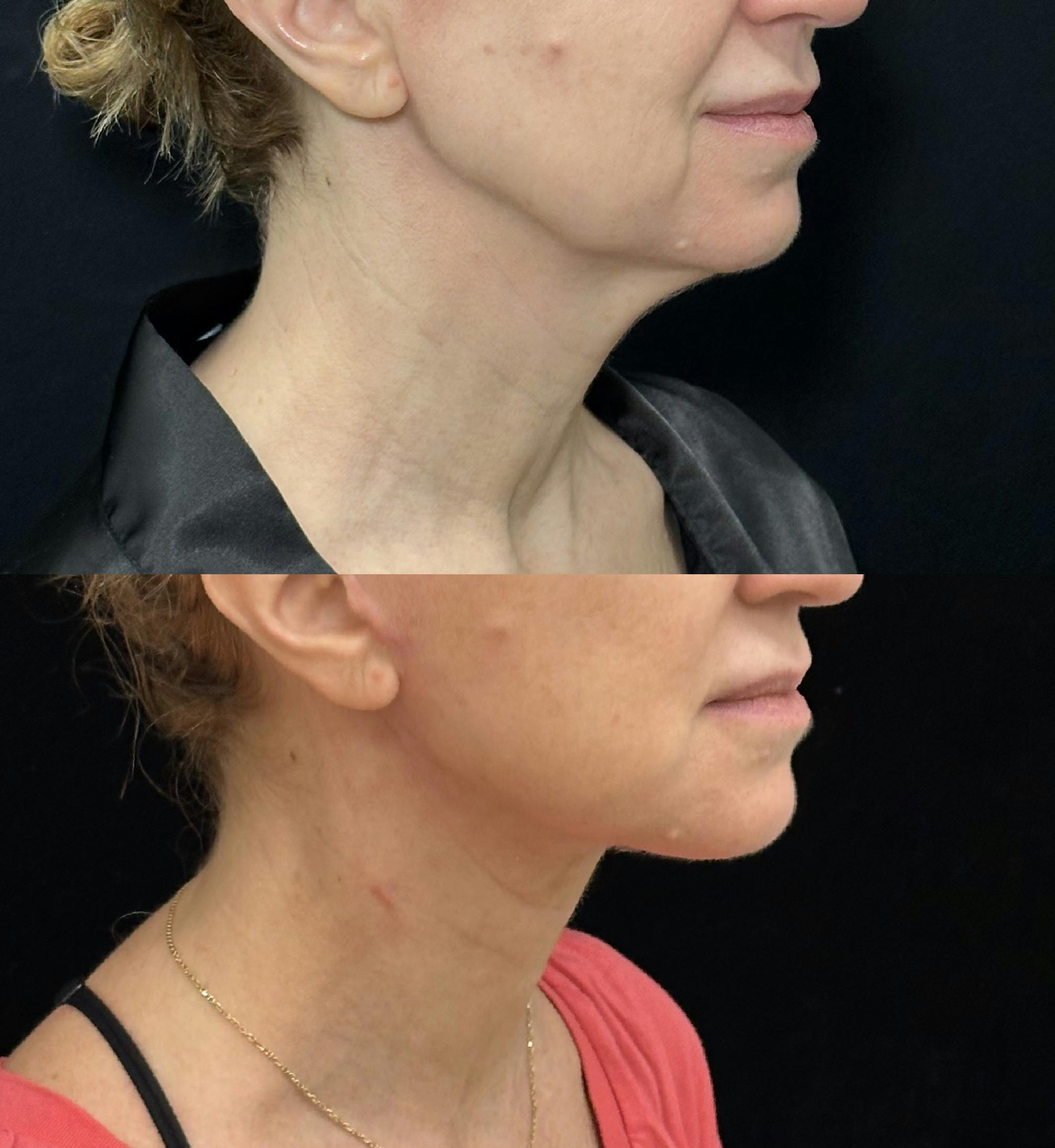 Deep Plane Facelift Before & After Gallery - Patient 116037 - Image 3