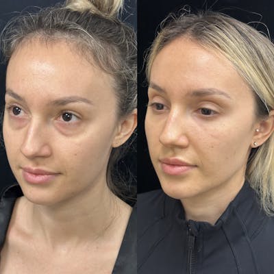 Lower Blepharoplasty Before & After Gallery - Patient 624326 - Image 4