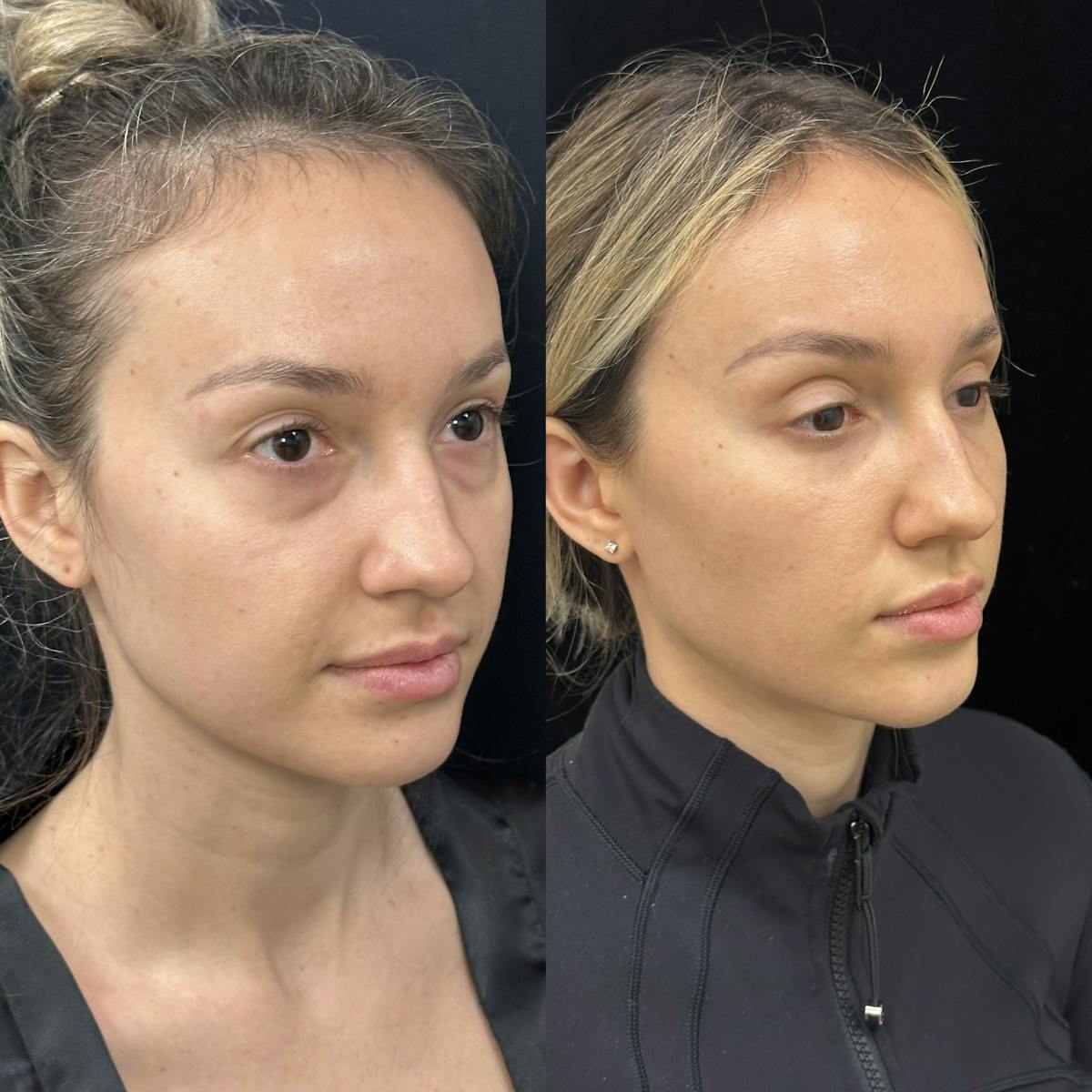 Lower Blepharoplasty Before & After Gallery - Patient 624326 - Image 3