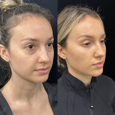 Lower Blepharoplasty Before & After Gallery - Patient 624326 - Image 3