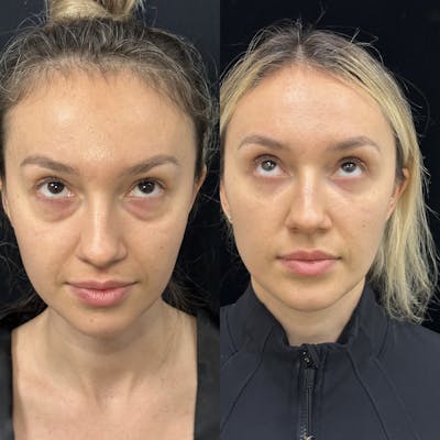 Lower Blepharoplasty Before & After Gallery - Patient 624326 - Image 2