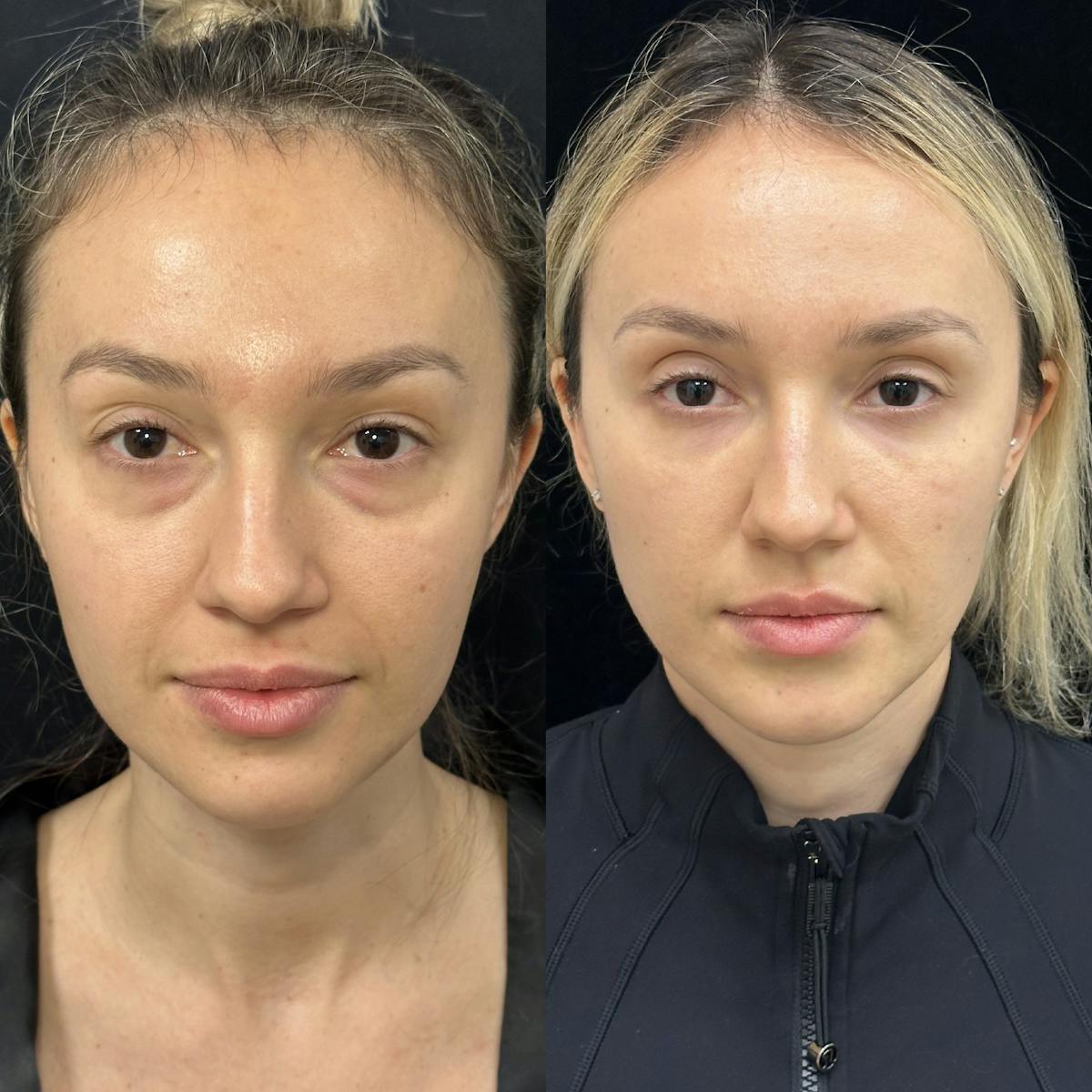Lower Blepharoplasty Before & After Gallery - Patient 624326 - Image 1