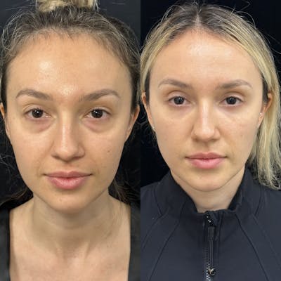 Facial Fat Transfer Before & After Gallery - Patient 104974 - Image 1