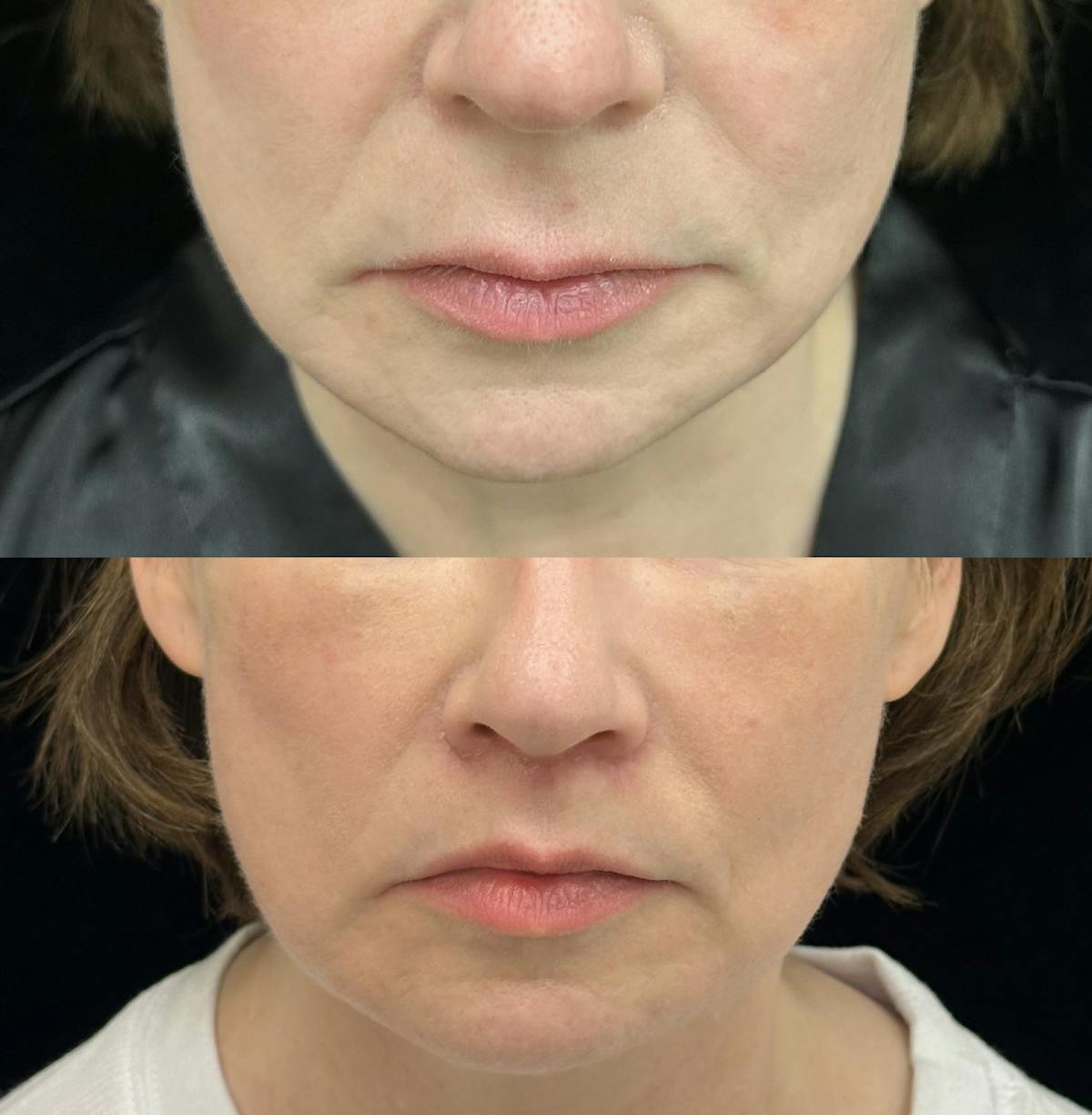 Lip Lift Before & After Gallery - Patient 240883 - Image 1