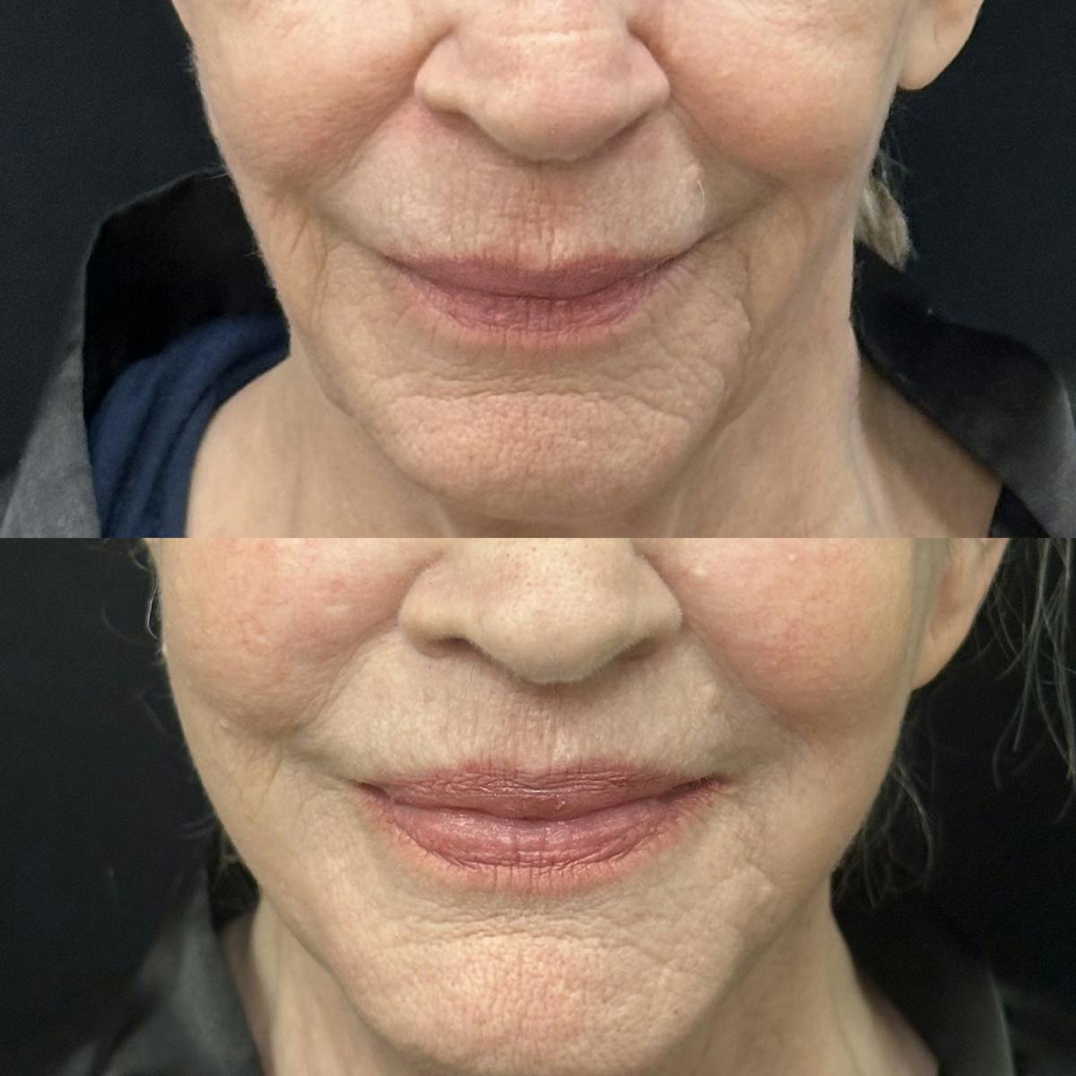 Lip Lift Before & After Gallery - Patient 211999 - Image 1