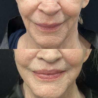 Lip Lift Before & After Gallery - Patient 211999 - Image 1