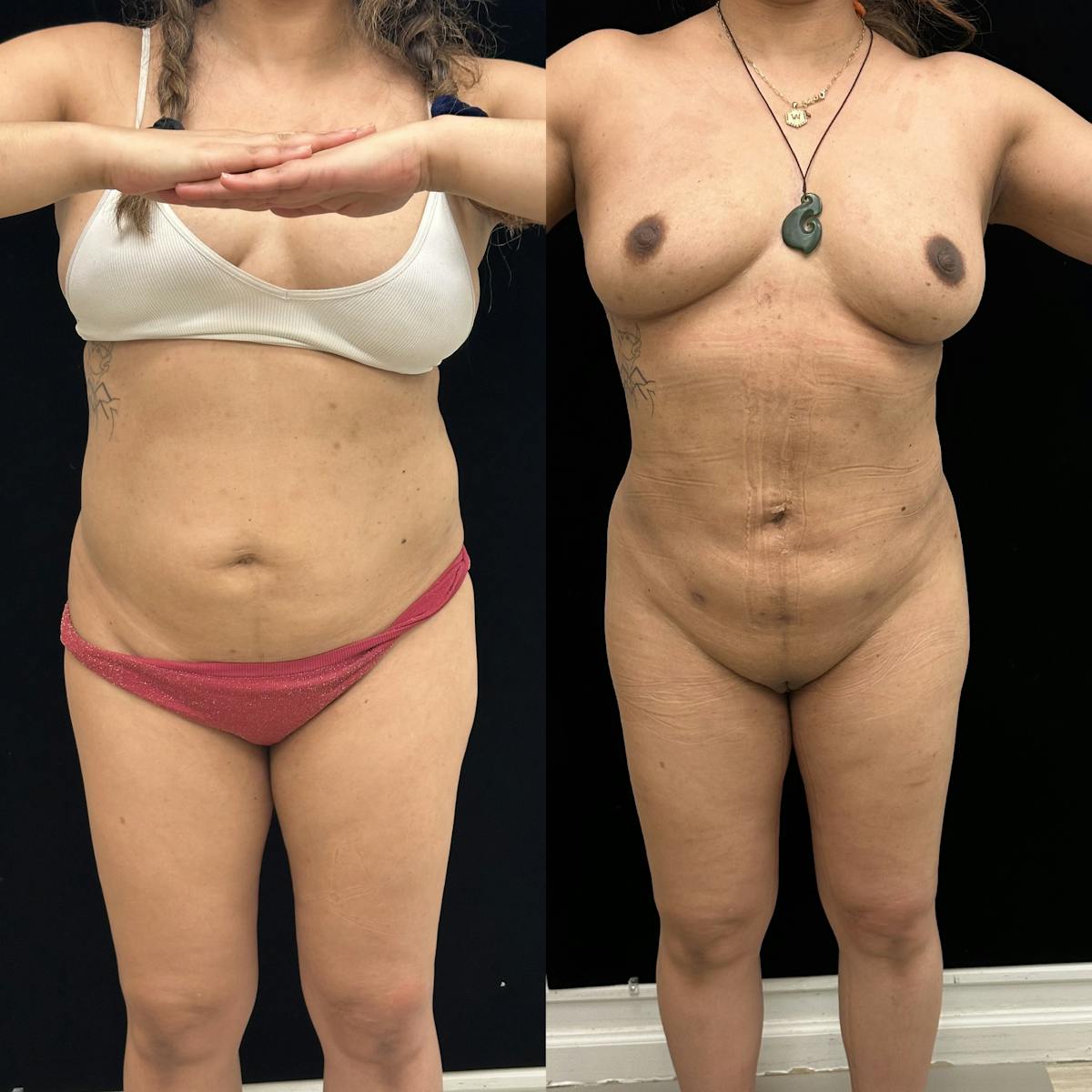 Liposuction Before & After Gallery - Patient 421241 - Image 1