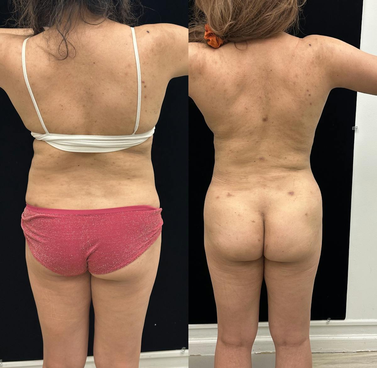 Liposuction Before & After Gallery - Patient 421241 - Image 6