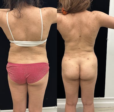 Liposuction Before & After Gallery - Patient 421241 - Image 6