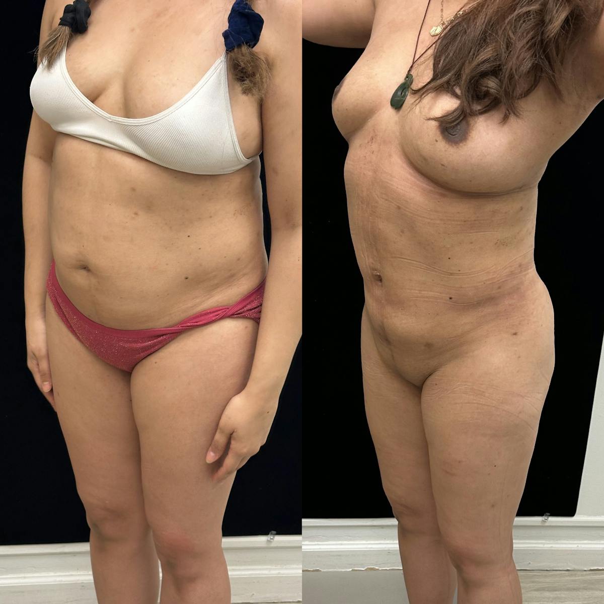 Liposuction Before & After Gallery - Patient 421241 - Image 4