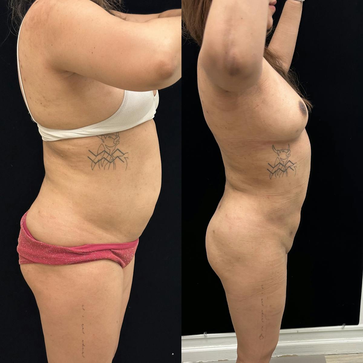 Liposuction Before & After Gallery - Patient 421241 - Image 3
