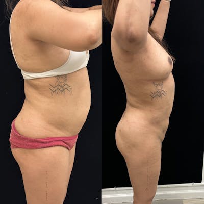 Liposuction Before & After Gallery - Patient 421241 - Image 3