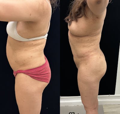 Liposuction Before & After Gallery - Patient 421241 - Image 5