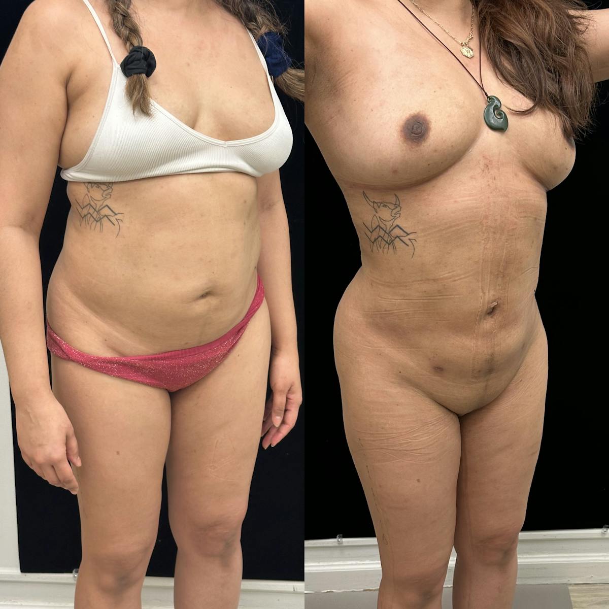 Liposuction Before & After Gallery - Patient 421241 - Image 2