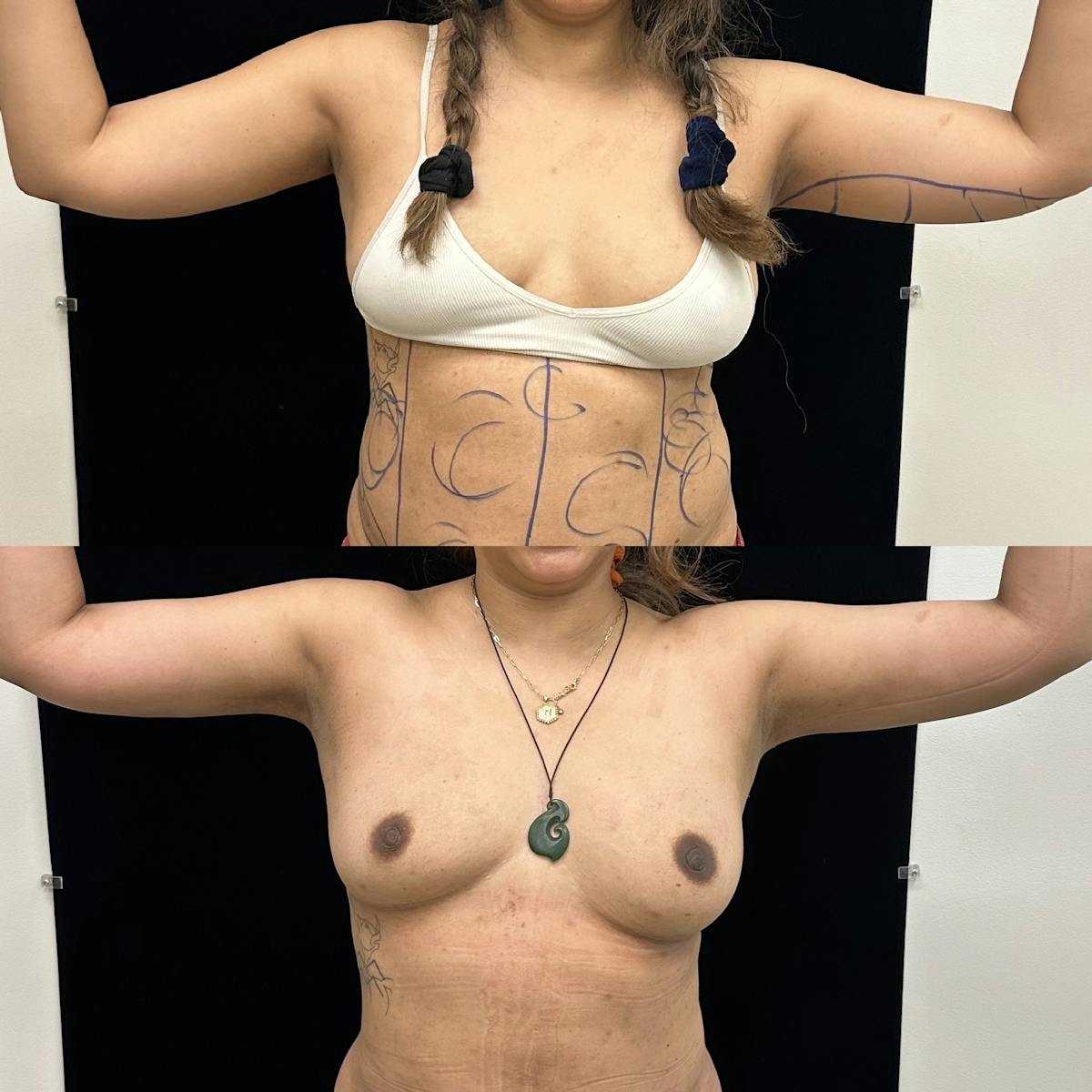 Arm Liposuction with Bodytite  Before & After Gallery - Patient 598474 - Image 1