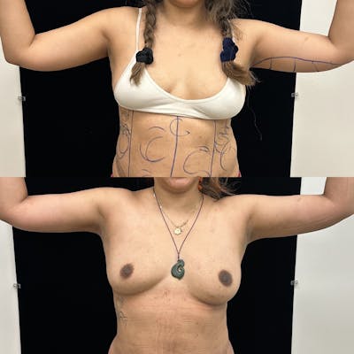 Arm Liposuction with Bodytite Before & After Gallery - Patient 598474 - Image 1