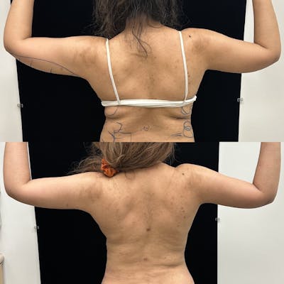 Arm Liposuction with Bodytite Before & After Gallery - Patient 598474 - Image 2