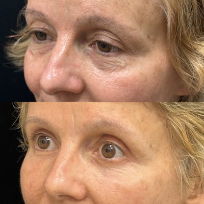 Lower Blepharoplasty Before & After Gallery - Patient 309565 - Image 4