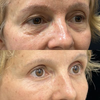 Lower Blepharoplasty Before & After Gallery - Patient 309565 - Image 3