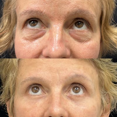 Lower Blepharoplasty Before & After Gallery - Patient 309565 - Image 2