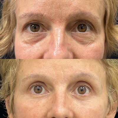 Lower Blepharoplasty Before & After Gallery - Patient 309565 - Image 1