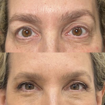 Upper Blepharoplasty Before & After Gallery - Patient 311900 - Image 1