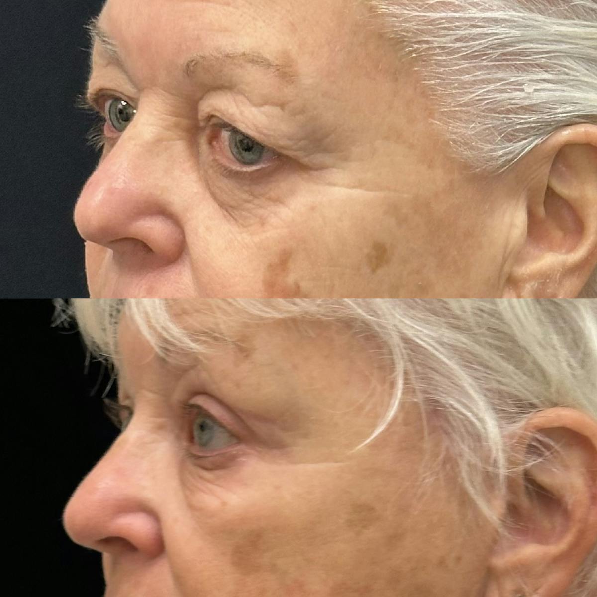  Upper Blepharoplasty Before & After Gallery - Patient 280293 - Image 2