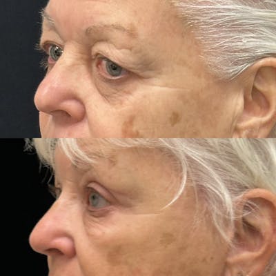 Upper Blepharoplasty Before & After Gallery - Patient 280293 - Image 2