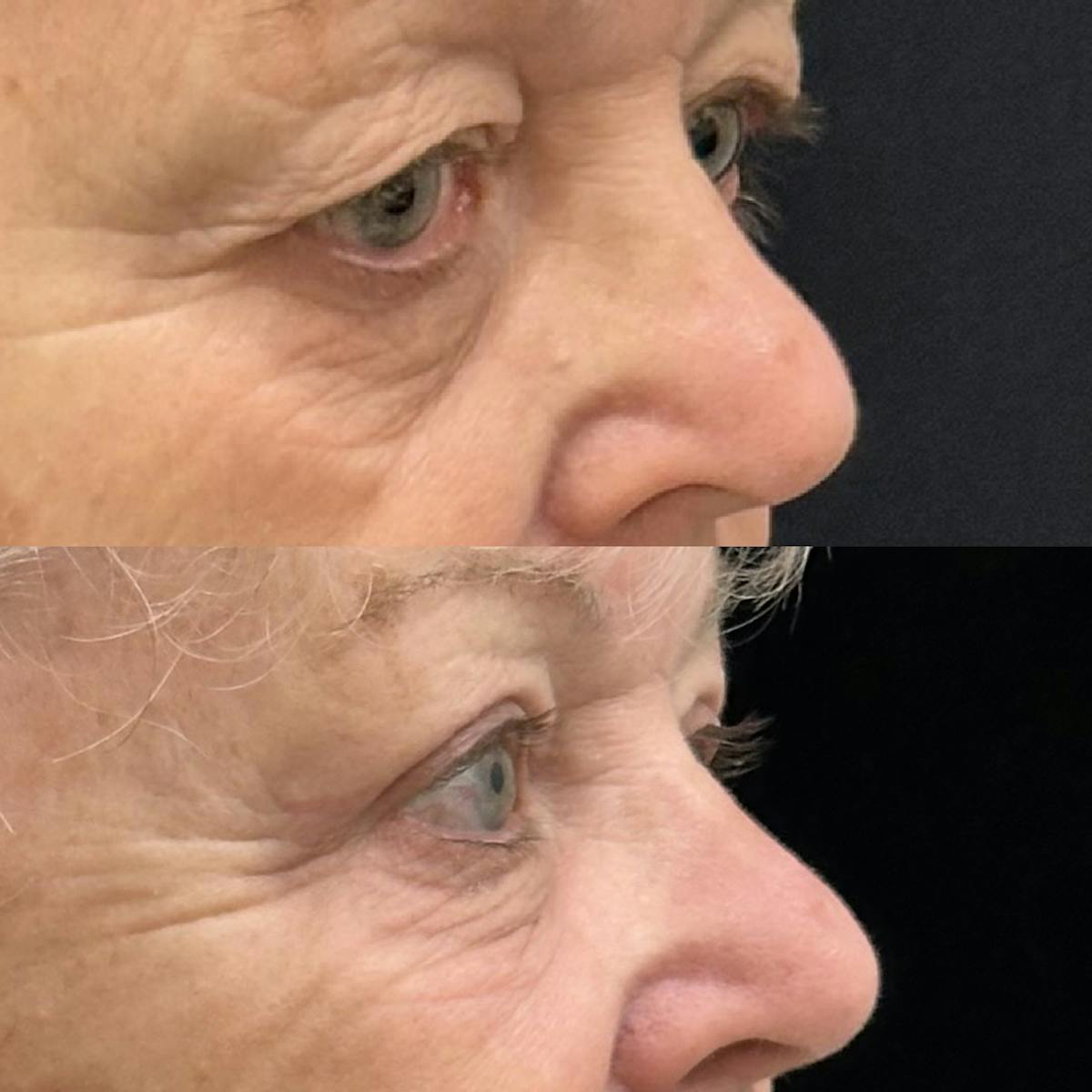  Upper Blepharoplasty Before & After Gallery - Patient 280293 - Image 1