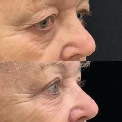 Upper Blepharoplasty Before & After Gallery - Patient 280293 - Image 1