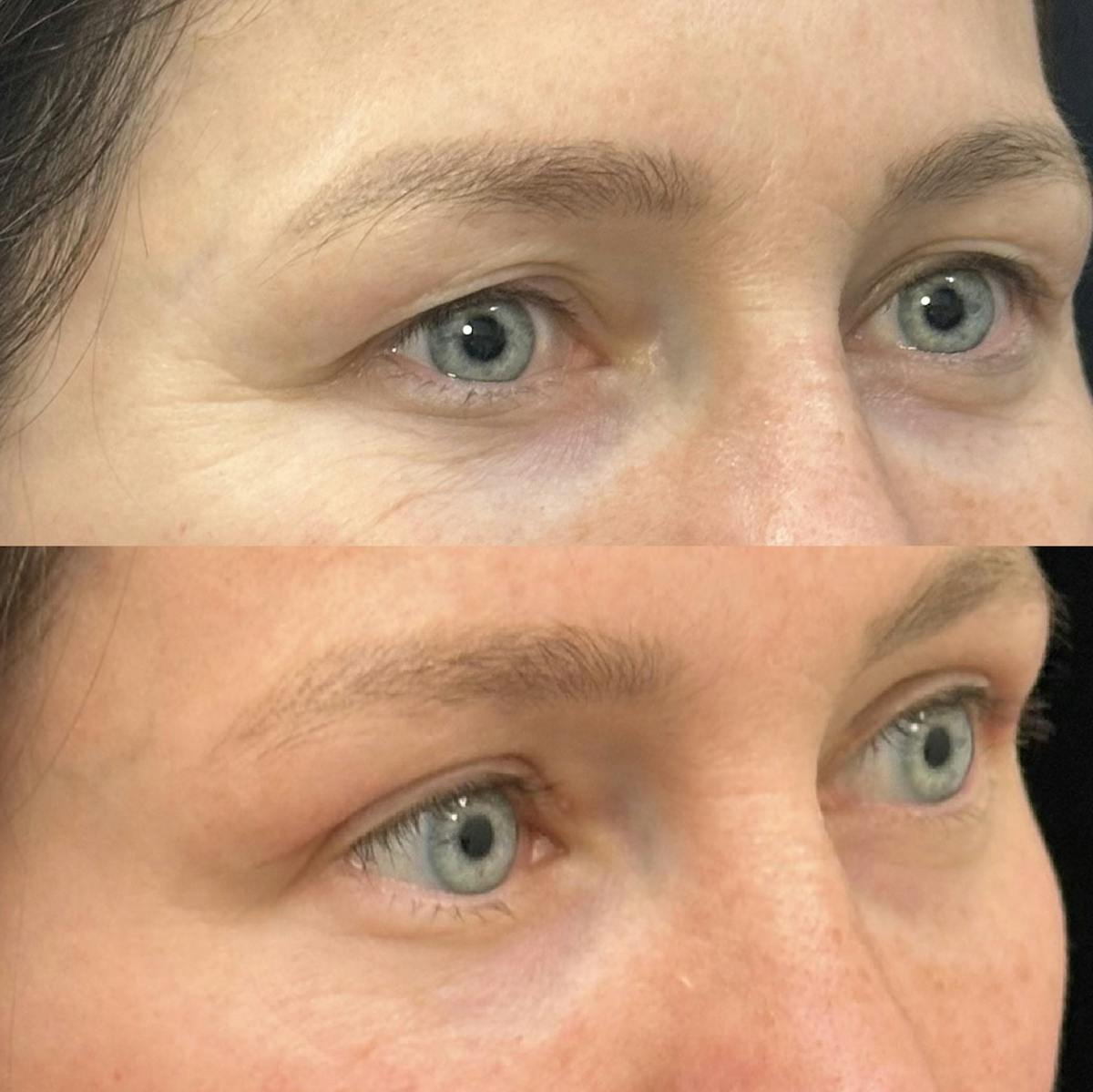  Upper Blepharoplasty Before & After Gallery - Patient 363263 - Image 2
