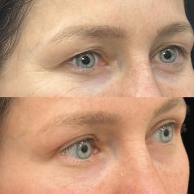 Upper Blepharoplasty Before & After Gallery - Patient 363263 - Image 2