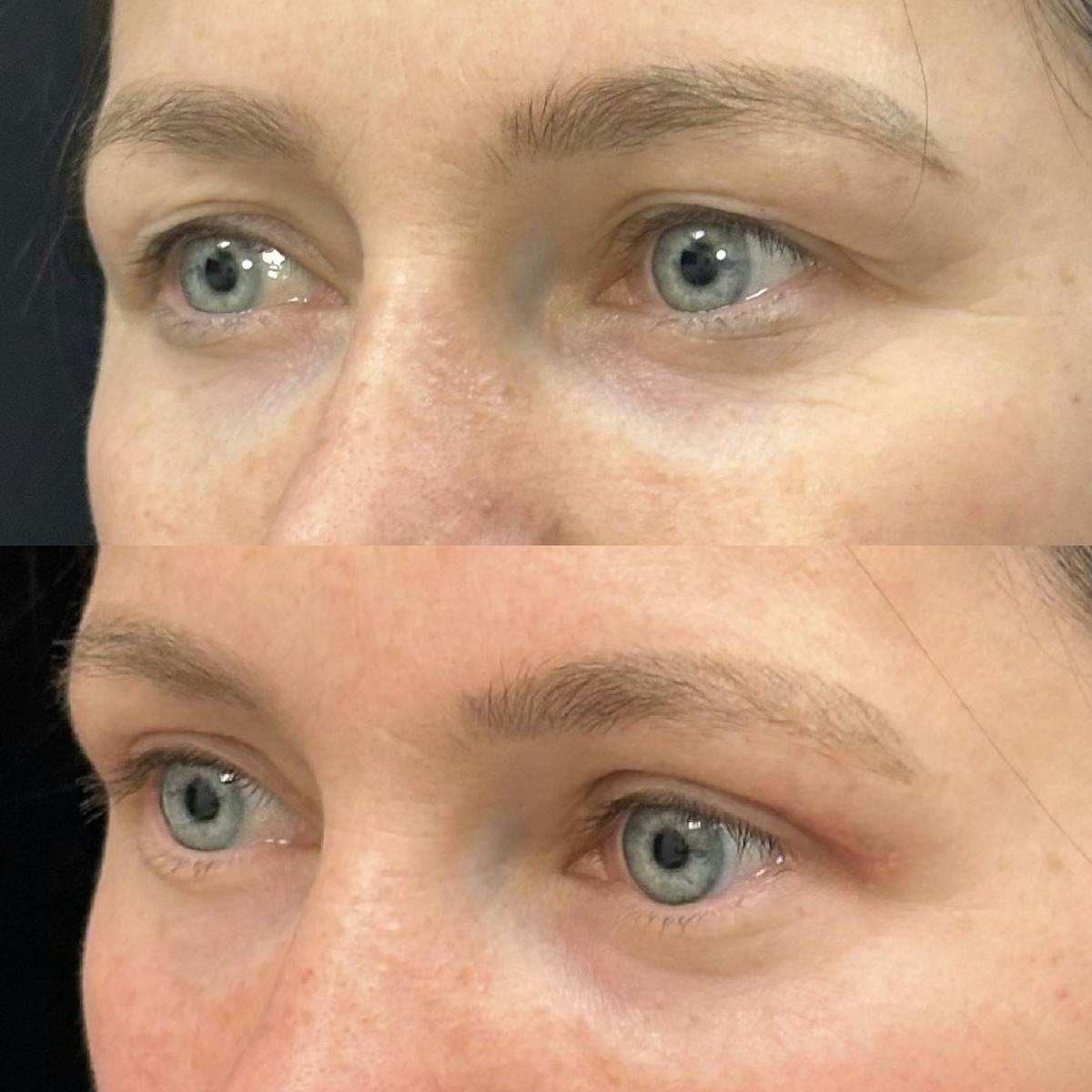  Upper Blepharoplasty Before & After Gallery - Patient 363263 - Image 3