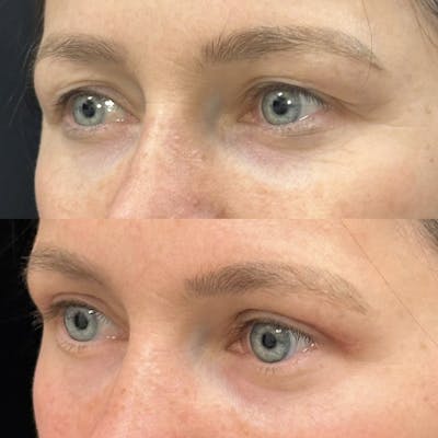 Upper Blepharoplasty Before & After Gallery - Patient 363263 - Image 3