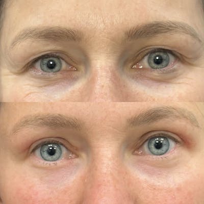 Upper Blepharoplasty Before & After Gallery - Patient 363263 - Image 1