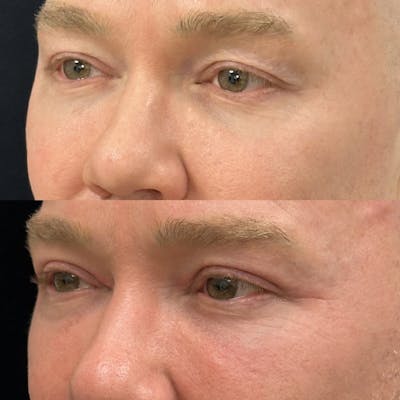 Upper Blepharoplasty Before & After Gallery - Patient 385881 - Image 3