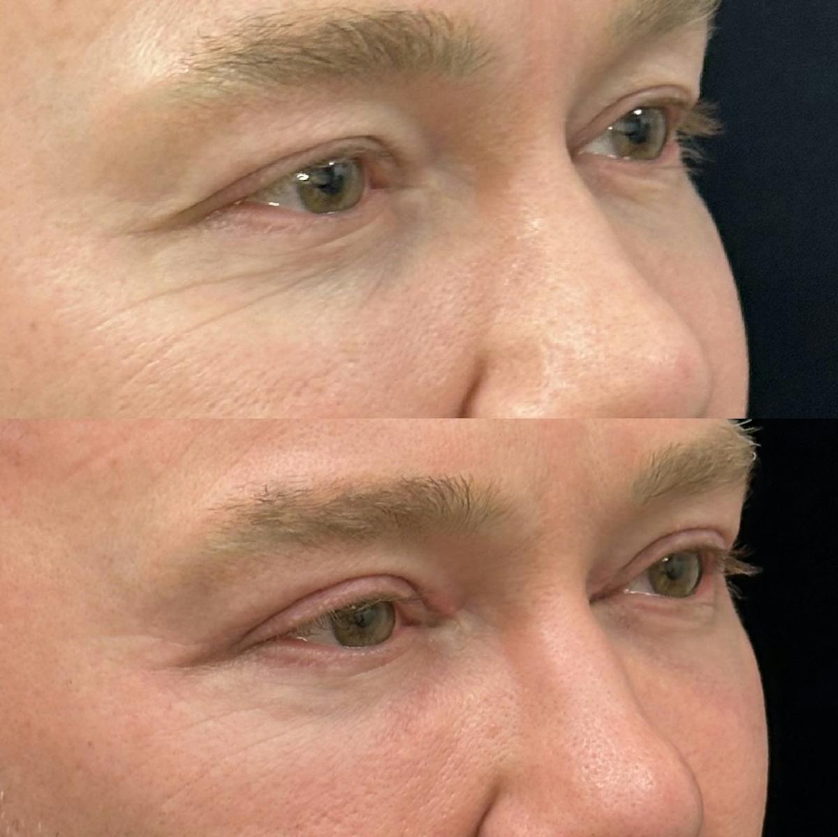  Upper Blepharoplasty Before & After Gallery - Patient 385881 - Image 2