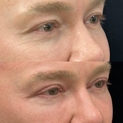 Upper Blepharoplasty Before & After Gallery - Patient 385881 - Image 2