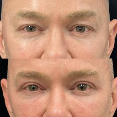 Upper Blepharoplasty Before & After Gallery - Patient 385881 - Image 1
