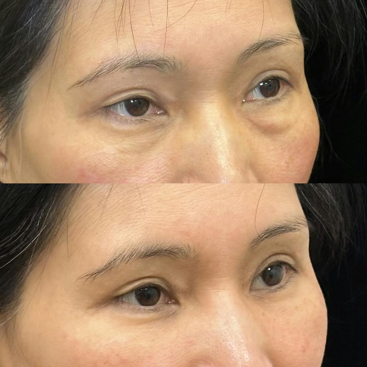  Facial Fat Transfer Before & After Gallery - Patient 386188 - Image 2