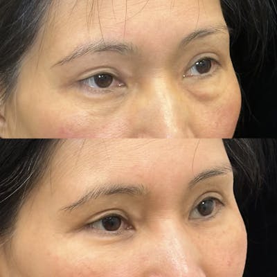 Lower Blepharoplasty Before & After Gallery - Patient 377740 - Image 2