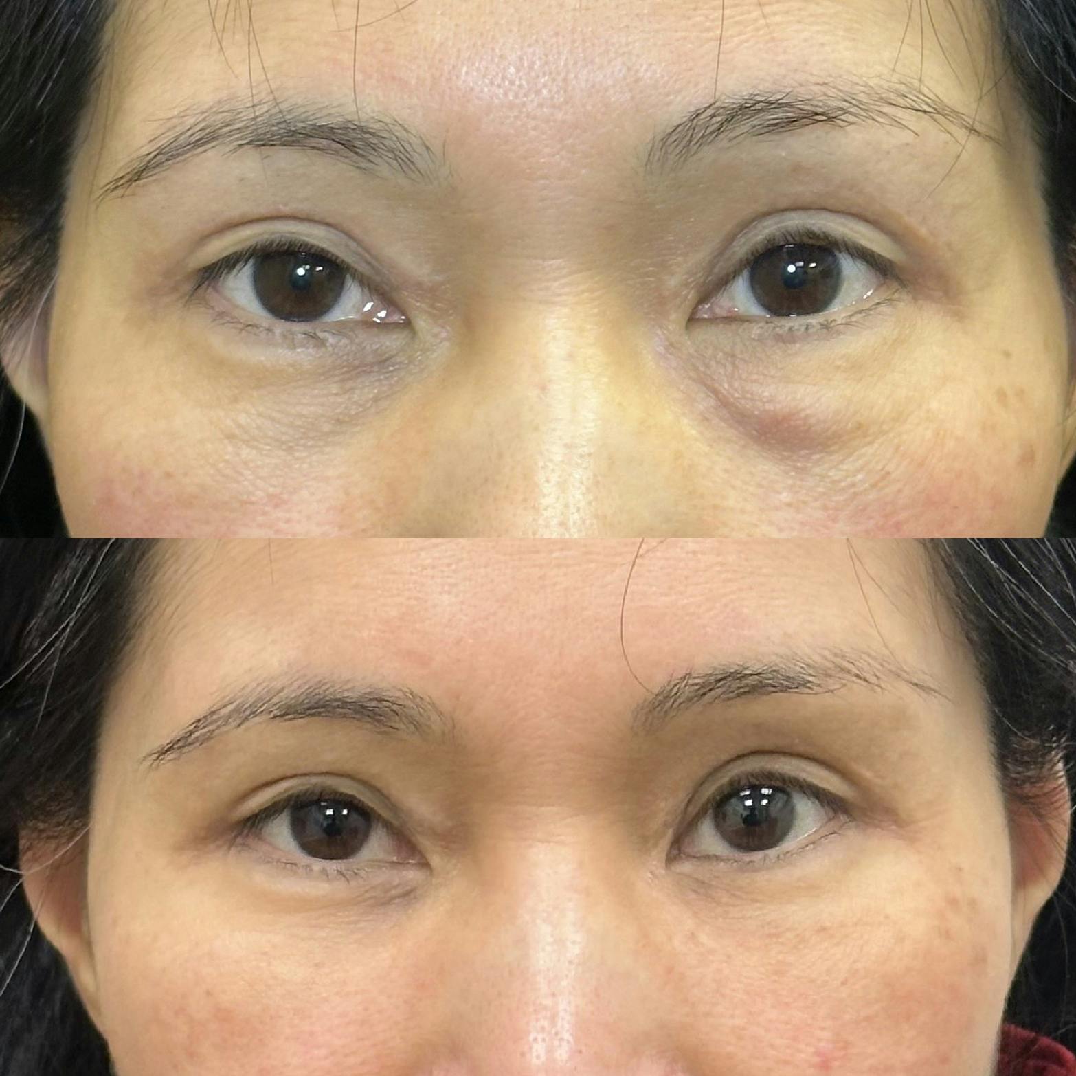 Lower Blepharoplasty Before & After Gallery - Patient 377740 - Image 1