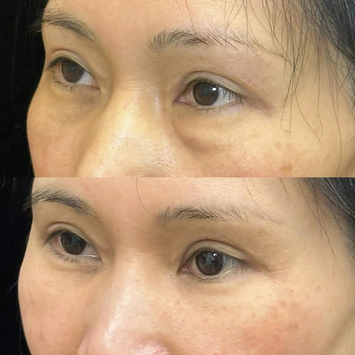  Facial Fat Transfer Before & After Gallery - Patient 386188 - Image 3