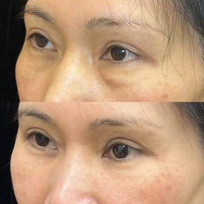 Lower Blepharoplasty Before & After Gallery - Patient 377740 - Image 3