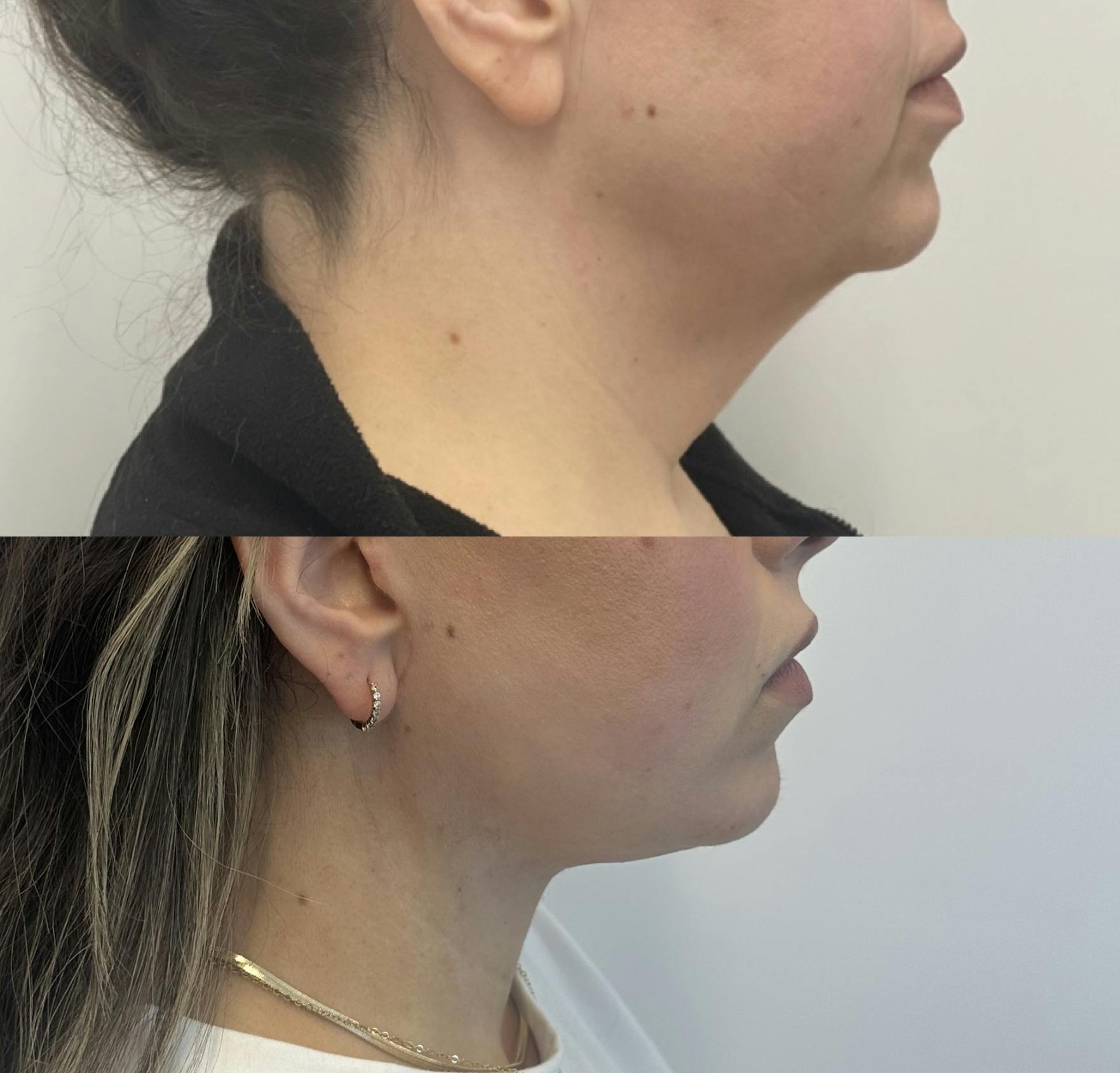Neck Lift
